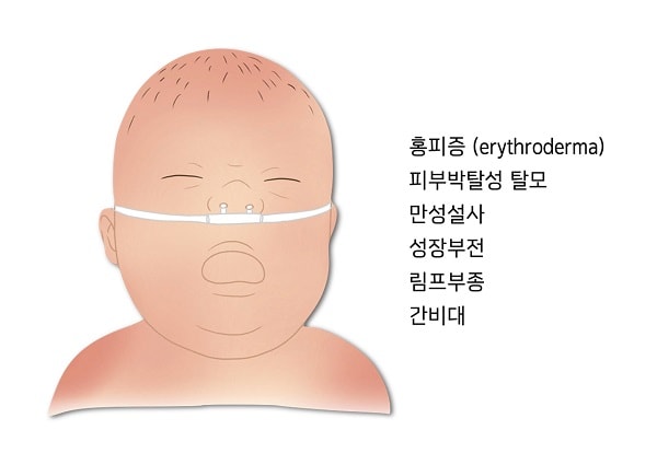 오멘증후군 증상 그림-홍피증(erythroderma),피부박탈성 탈모,만성설사,성장부전,림프부종,간비대