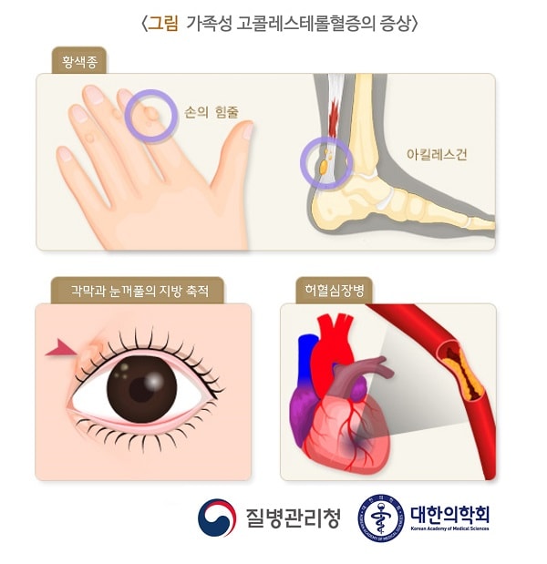 가족성 고콜레스테롤혈증의 증상 그림-황색종:손의 힘즐,아킬레스건,각막과 눈꺼풀의 지방 축척,허혈심장병