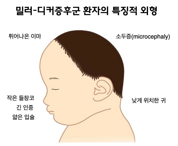 밀러-디커증후군 환자의 특징적 외형 그림-튀어나온 이마,소두증(microcephaly),작은 들창코,긴 인중,얇은 입술, 낮게 위치한 귀