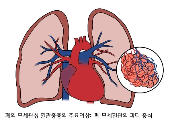 폐의 모세관성 혈관종증 그림-폐의 모세관성 혈관종증의 주요이상:폐 모세혈관의 과다 증식