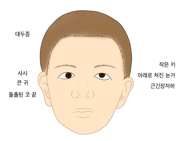 15번 염색체 장완 13.3 부분의 미세결손 그림: 대두증, 사시, 큰 귀, 돌출된 코 끝, 작은 키, 아래로 처진 눈가, 근긴장저하