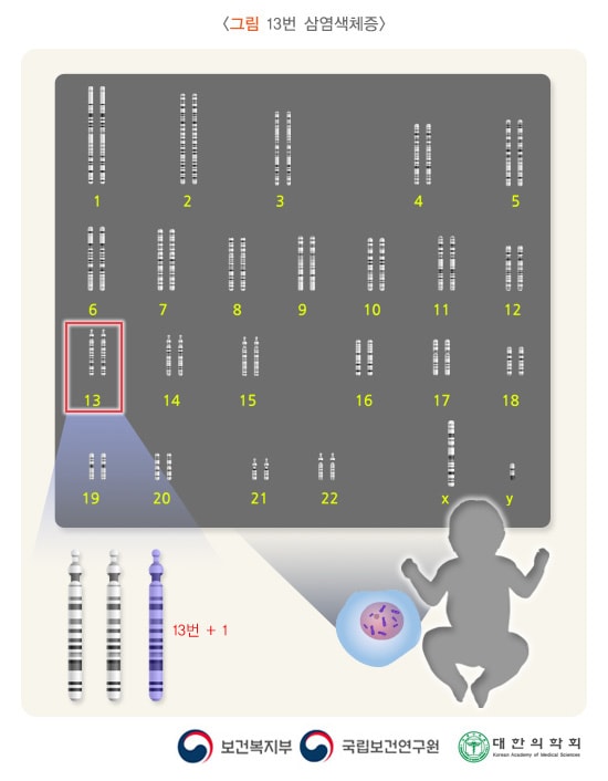 13번 삼염색체증