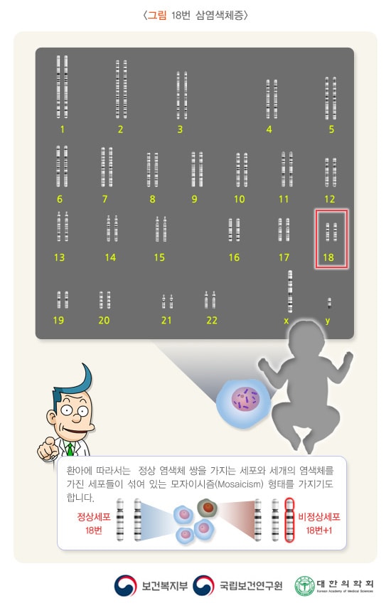 18번 삼염색체증/환아에 따라서는 정상 염색체 쌍을 가지는 세포와 세개의 염색체를 가진 세포들이 섞여 있는 모자이시즘(Mosaicism) 형태를 가지기도 합니다./정상세포18번/비정상세포18번+1