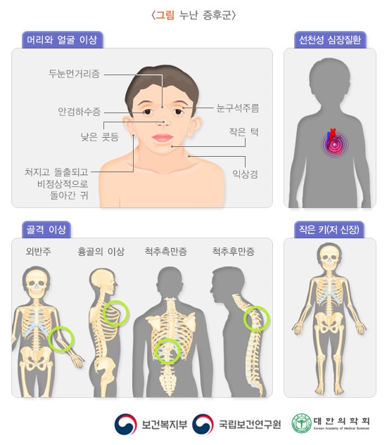 누난 증후군