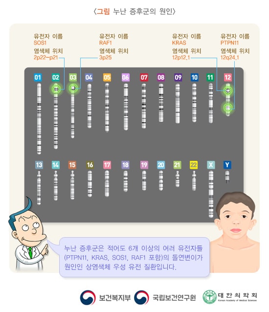 누난 증후군의 원인