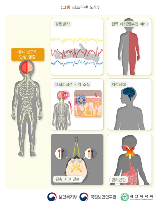 라스무센 뇌염: 대뇌의 반구에 만성 염증(뇌염)이 특징이고 경련발작, 한쪽 마비(반부전 마비)와 지적장애, 대뇌피질성 감각 소실, 편측 시야 결손, 연하곤란 등의 증상 그림