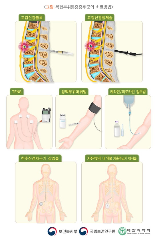 복합부위통증증후군의 치료방법