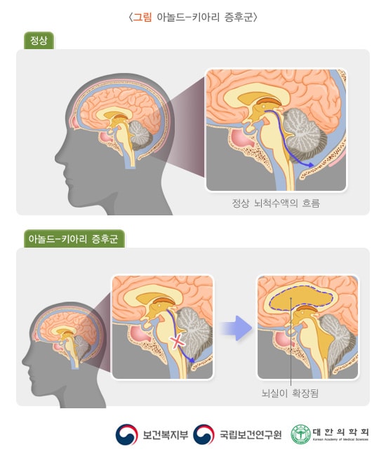 아놀드-키아리 증후군