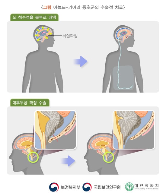 아놀드-키아리 증후군의 수술적 치료