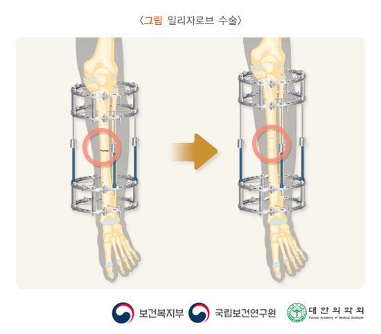 일리자로브 수술