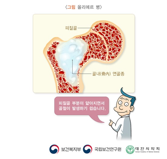 올리에르 병