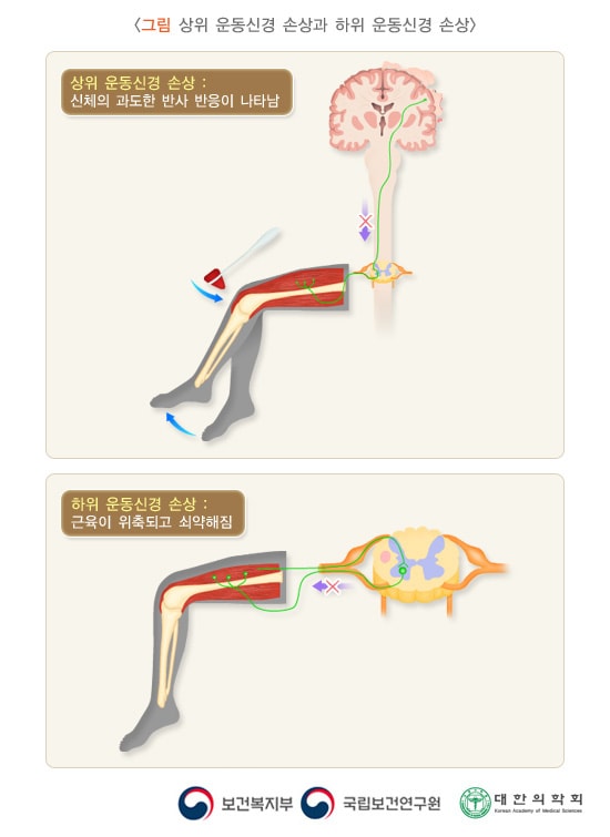 상위 운동신경 손상과 하위 운동신경 손상