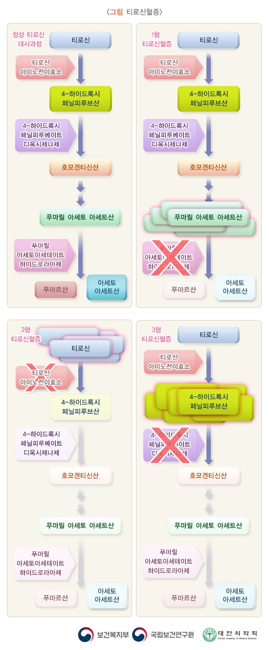 티로신혈증