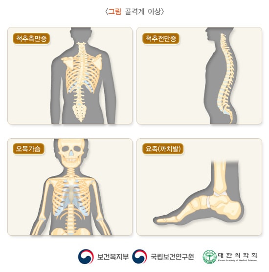 골격계 이상
