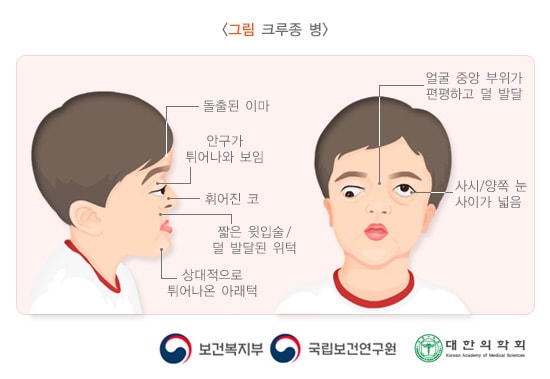 크루종병