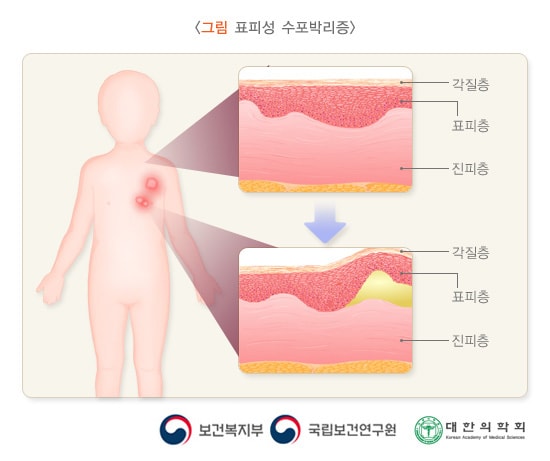 수포성 표피박리증