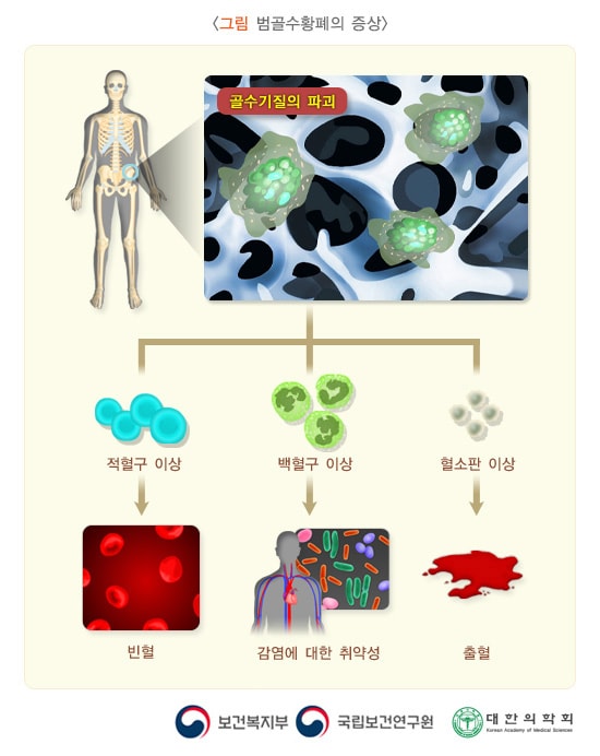 그림 범골수황폐의 증상. 골수기질의 파괴. 적혈구이상 > 빈혈. 백혈구 이상> 감염에 대한 취약성. 혈소판이상> 출혈.보건복지부, 국립보건연구원, 대한의학회