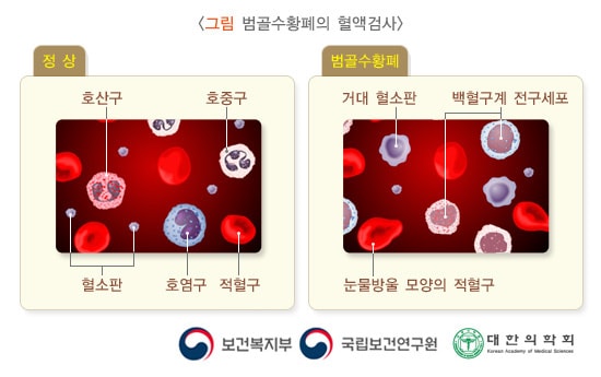 그림 범골수황폐의 혈액검사. 정상> 호산구, 혈소판, 호중구, 호염구, 적혈구. 범골수황폐> 거대 혈소판, 백혈구계 전구세포, 눈물방울 모양의 적혈구. 보건복지부, 국립보건연구원, 대한의학회