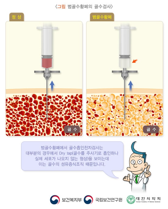 그림 범골수황폐의 골수검사. 범골수황폐에서 골수흡인천자검사는 대부분의 경우에서 Dry tap(골수를 주사기로 흡인하나 실제 세포가 나오지 않는 형상)을 보이는데 이는 골수의 섬유증식조직 때문입니다. 보건복지부, 국립보건연구원, 대한의학회