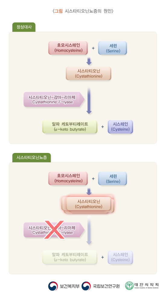 시스타티오닌뇨증의 원인