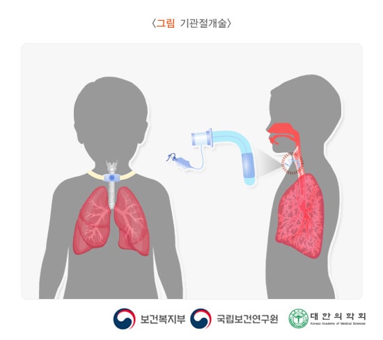 기관절개술