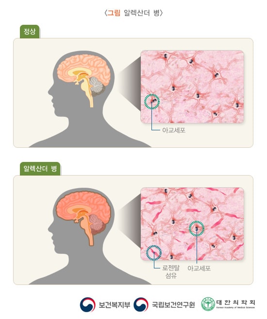 알렉산더병: 정상인의 아교세포와 알렉산더 병의 아교세포, 로젠탈 섬유 비교 사진