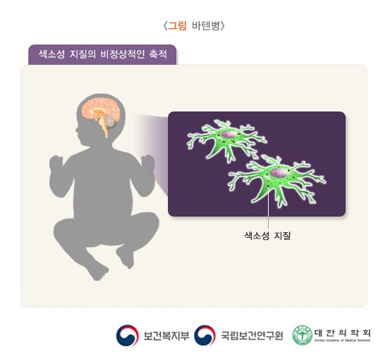 바텐병