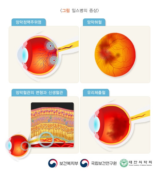 일스병의 증상 그림. 망망정맥주위염, 망망허혈, 망막혈관의 변형과 신생혈관, 유리체출혈. 보건복지부, 국립보건연구원, 대한의학회
