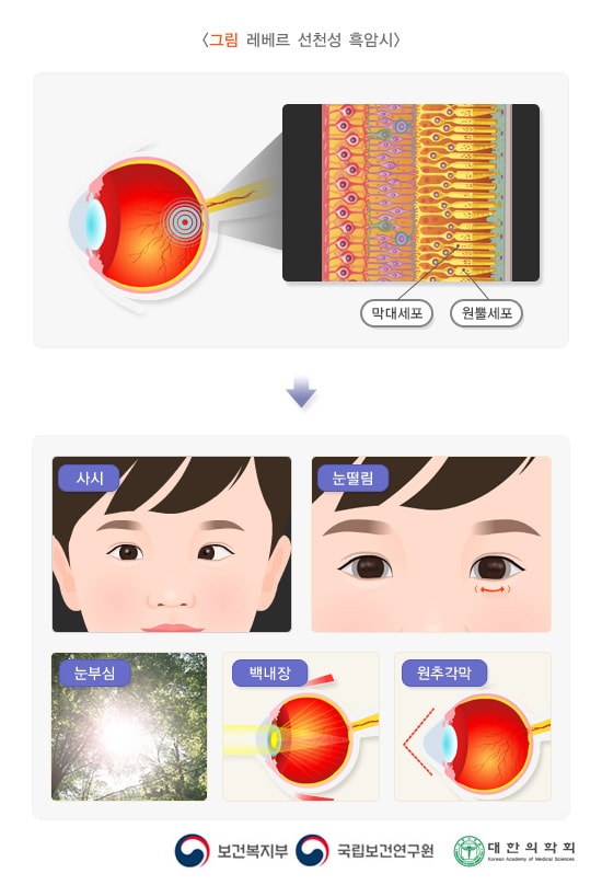레베르 선천성 흑암시 개요 이미지. 안구 내부 막대세포, 원뿔세포 > 사시, 눈떨림, 눈부심, 백내장, 원추각막. 보건복지부, 국립보건연구원, 대한의학회