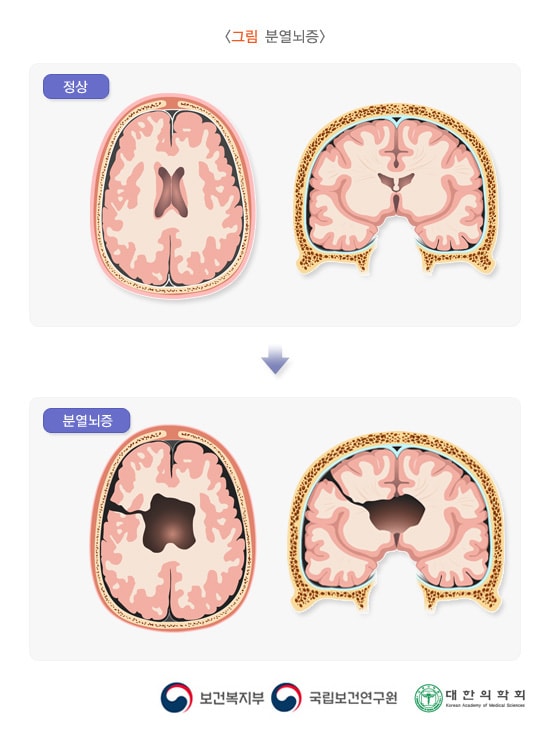 분열뇌증