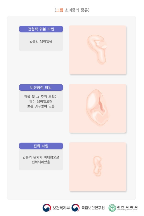 소이증의 종류