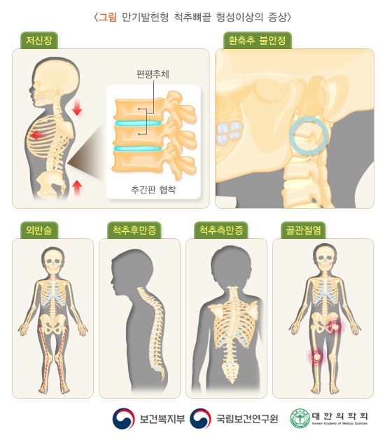 만기발현형 척추뼈끝 형성이상