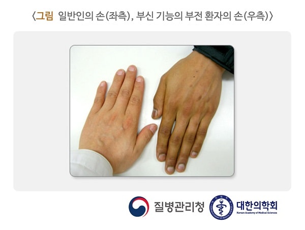일반인의 손(좌측), 부신 기능의 부전 환자의 손(우측)