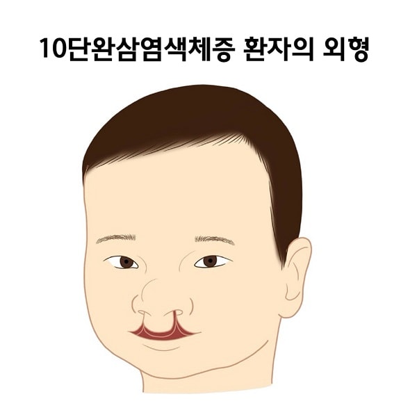 10단완삼염색체증 환자의 외형 그림
