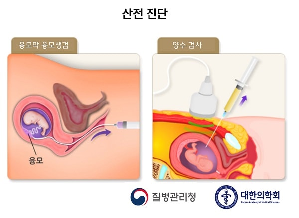 산전 진단 종류 그림: 융모막 융모생검, 양수검사