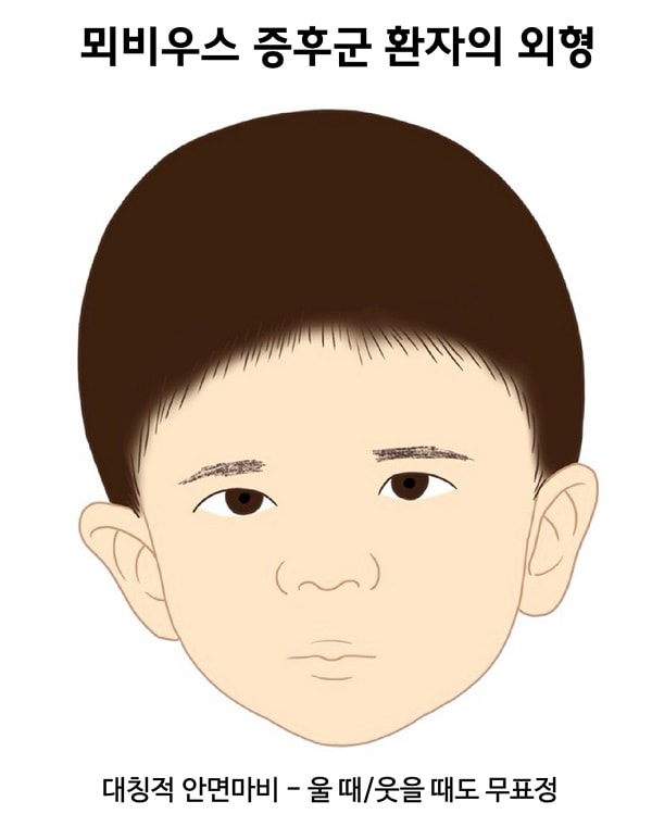 뫼비우스 증후군 환자의 외형 그림
