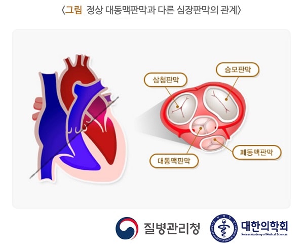 정상 대동맥판막과 다른 심장판막의 관계 그림