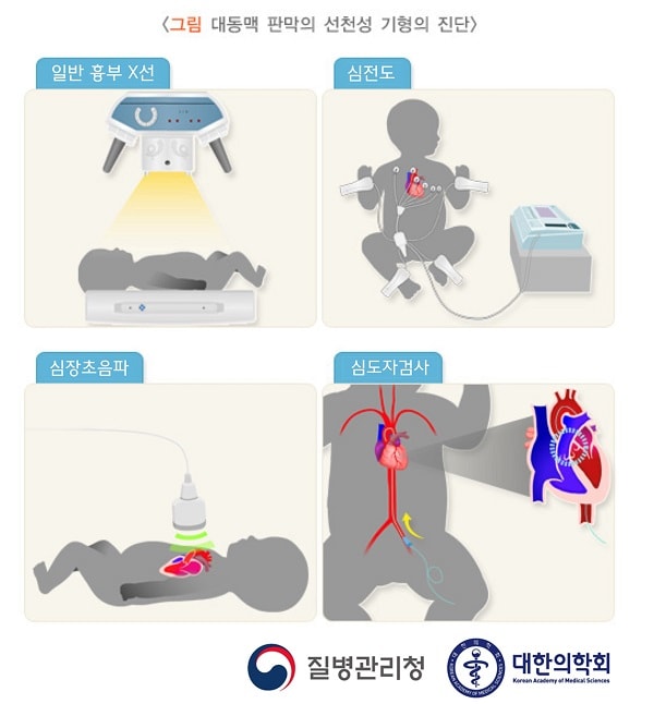 대동맥 판막의 선천성 기형의 진단 그림: 일반 흉부 X선, 심전도, 심장초음파, 심도자검사