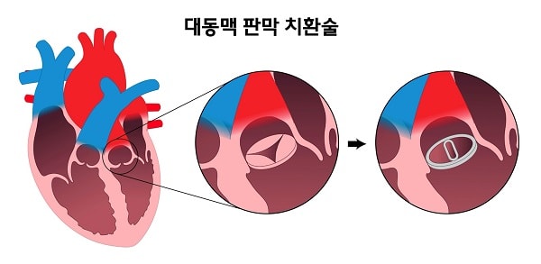대동맥 판막 치환술 그림