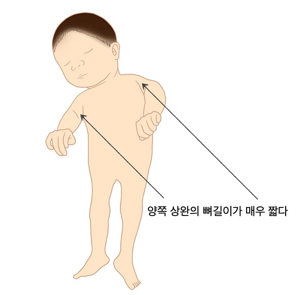 양쪽 상완의 뼈길이가 매우 짧은 예시 그림