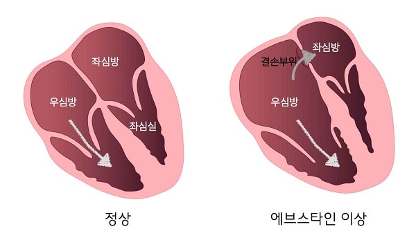 에브스타인 이상 환자의 우심방, 좌심방 그림