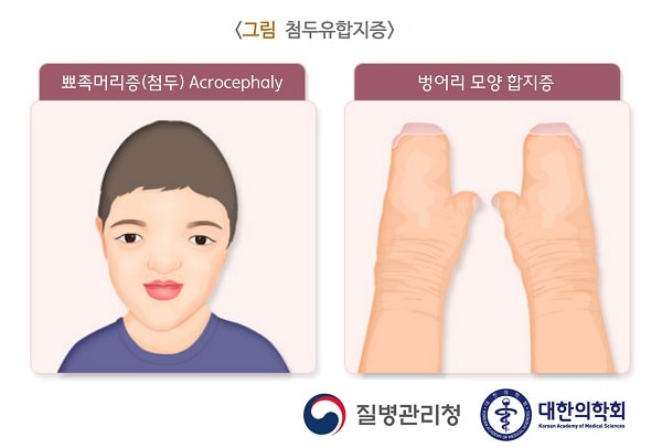 첨두유합지증 환자의 외형과 손 그림