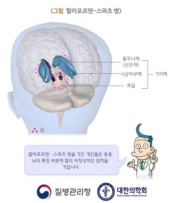 할러포르덴-스파츠 병 그림. 기저핵부분인 줄무늬체(선조체), 시상하부핵, 흑질에 철. 할러포르덴-스파츠 병을 가진 개인들은 종종 뇌의 특정 부분에 철의 비정상적인 침착을 가집니다. 질병관리청, 대한의학회