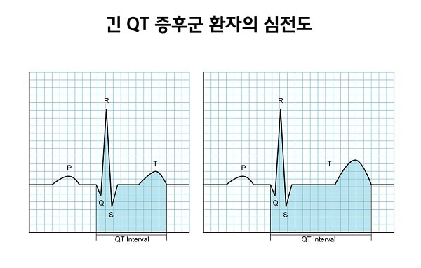 긴QT 증후군 환자의 심전도 그림