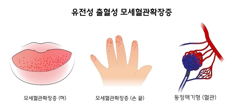 유전성 출혈성 모세혈관확장증 증상 그림-모세혈관확장증(형), 모세혈관확장증(손끝),동정맥기형(혈관)