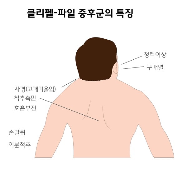 클리펠-파일 증후군의 특징-청력이상,구개열,사경(고개기울임),척추측만,호흡부전,손갈퀴,이분척추