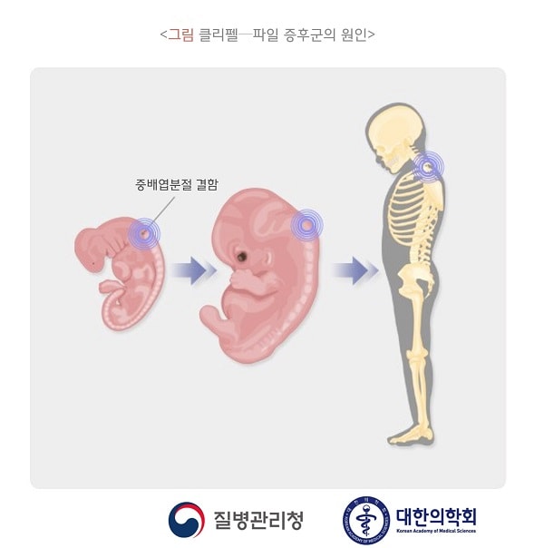 클리펠-파일 증후군의 원인 그림-중배엽분절 결함