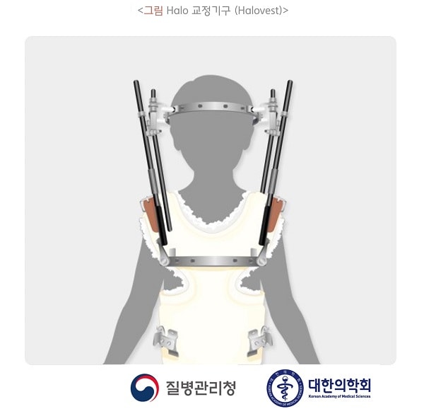 Halo 교정기구(Halovest) 그림