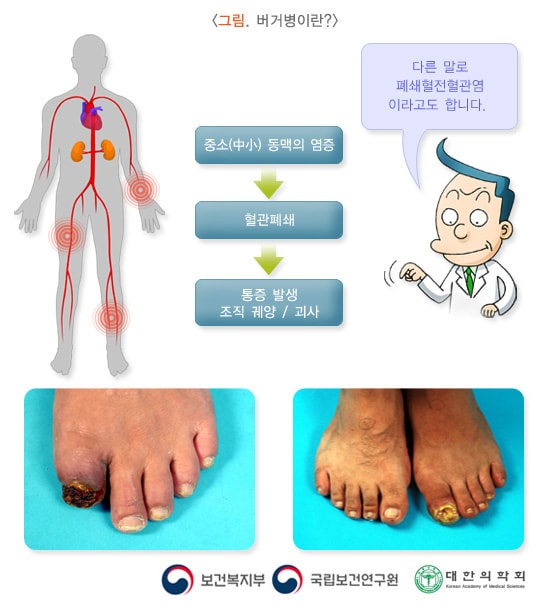 그림. 버거병이란? 중소(中小) 동맥의 염증> 혈관폐쇄> 통증 발생 조직 궤양/괴사. 다른 말로 폐쇄혈전혈관염이라고도 합니다. 보건복지부, 국립보건연구원, 대한의학회