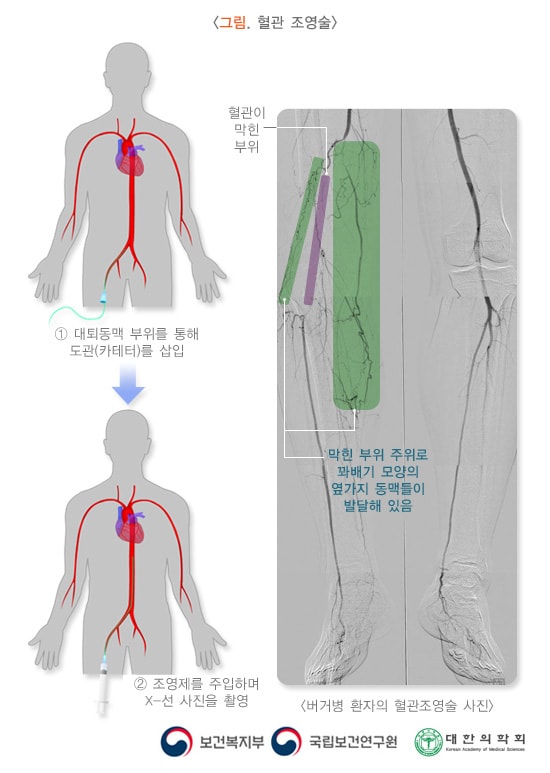 그림. 혈관 조영술. 버거병 환자의 혈관조영술 사진. 혈관이 막힌 부위 주위로 꽈배기 모양의 옆가지 동맥들이 발달해 있음. 1. 대퇴동맥 부위를 통해 도관(카테터)를 삽입. 2. 조영제를 주입하며 X-선 사진을 촬영. 보건복지부, 국립보건연구원, 대한의학회